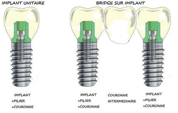 implant bridge