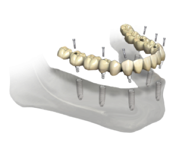 6 implants fixe