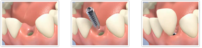 implant